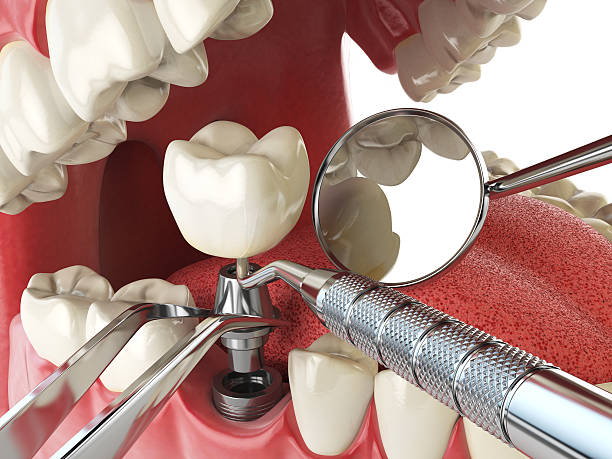 Best Emergency Tooth Extraction in Winter Springs, FL